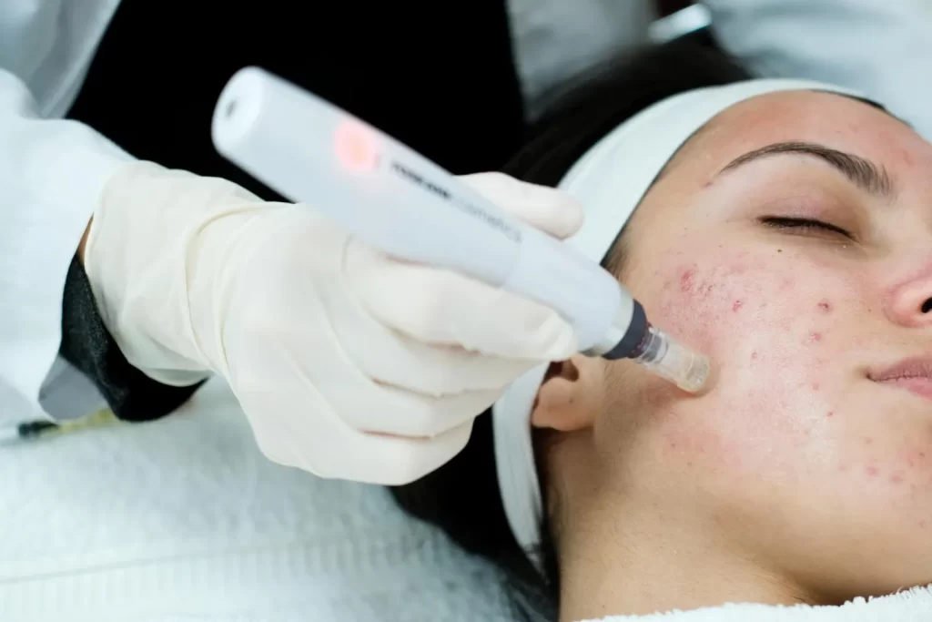 laser acne scar treatment hurt เลเซอร์หลุมสิว